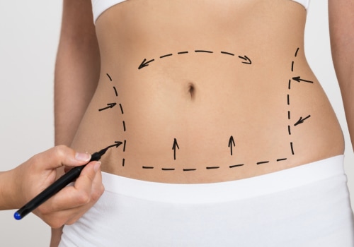 What You Need to Know About a Tummy Tuck Cosmetic Surgeon
